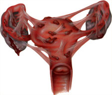 endometriosis-stage
